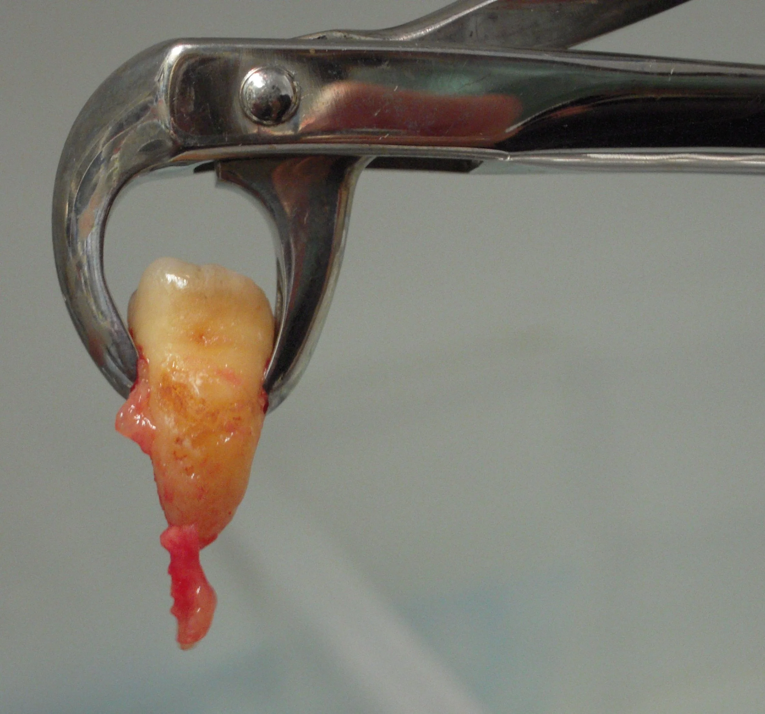 Delayed Root Canal Treatment