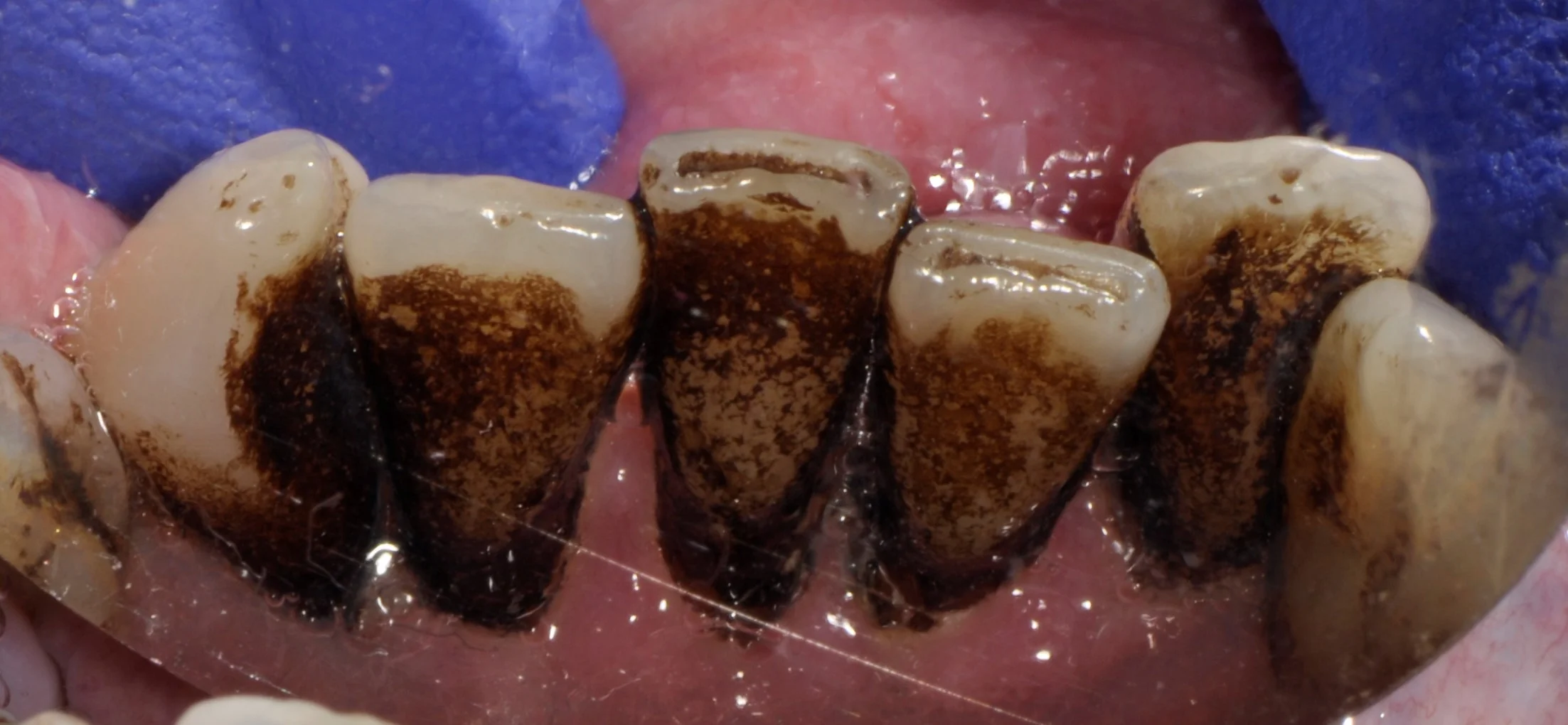 Delayed Hygiene Visit