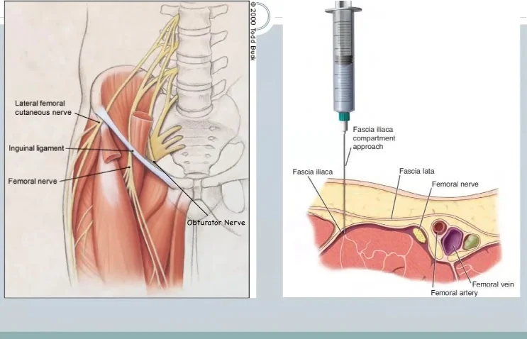 Fascia Iliaca Compartment Block — Downeast Emergency Medicine