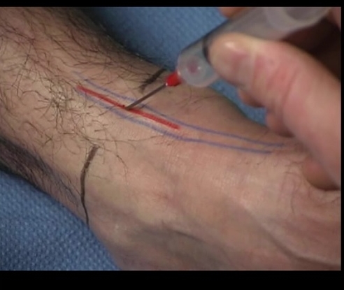 BLack = superior border of medial and lateral malleoli; blue = tibialis anterior and extensor hallicus longus; red = deep peroneal nerve
