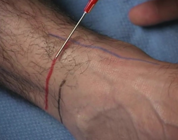 black = superior portion of lateral malleolus; blue = tibialis anterior tendon; red = approximate injection point for superficial peroneal nerve
