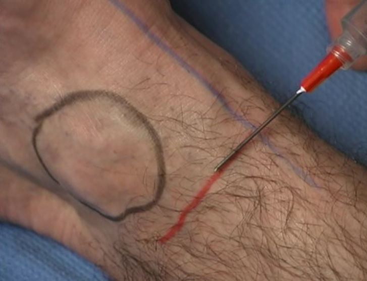 Black = medial malleolus; blue = tibialis anterior; red = approximate injection point