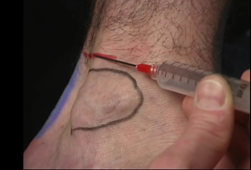 Black = Lateral malleolus; blue= achilles tendon; red = injection area