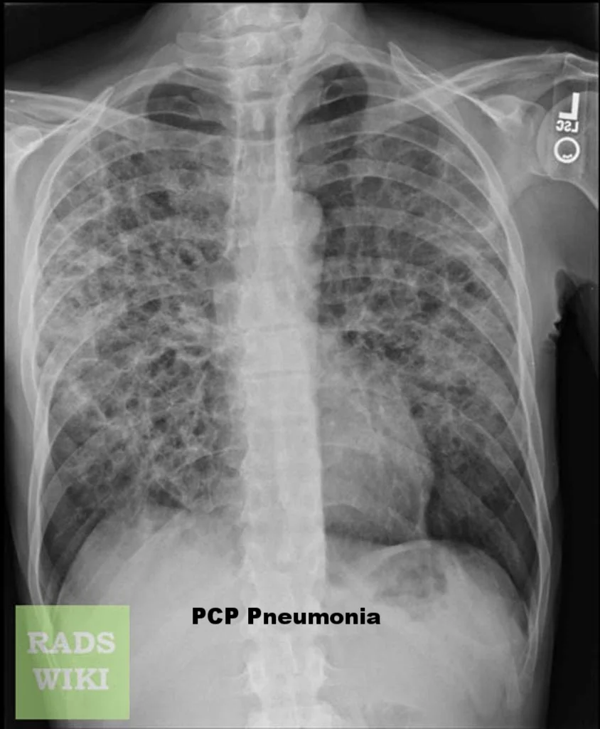There are diffuse bilaterally symmetric interstitial patten noted in the perihilar region and extending towards the periphery. Multiple ill defined small hyperlucent patches are noted in the bilateral lung fields especially in the mid zones suggestive of pneumatocele. https://radiopaedia.org/cases/pneumocystis-carinii-pneumonia-1