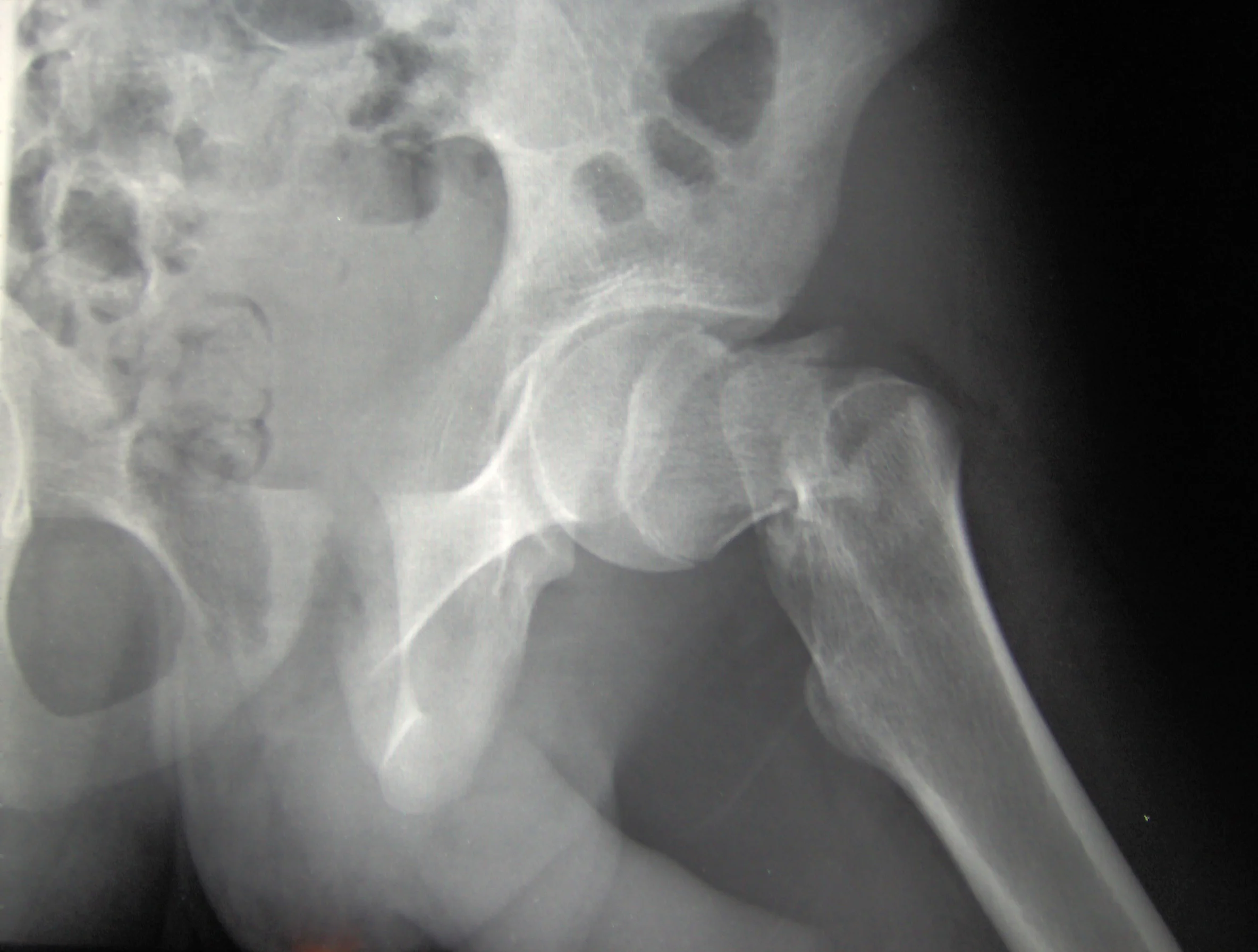 Cdm_hip_fracture_343.jpg