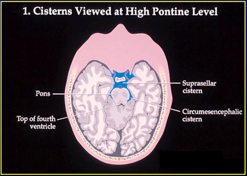 Blood Can Be Very Bad! - How to Read an Emergent Head CT — Downeast ...