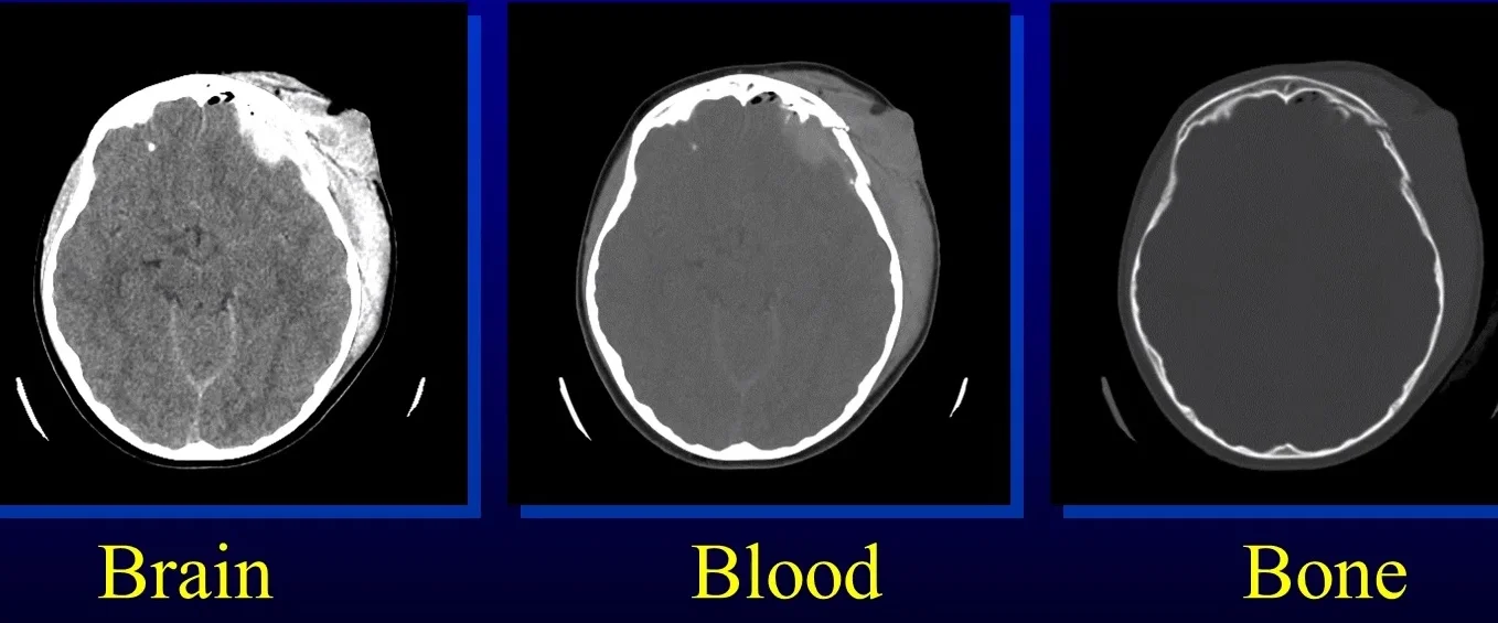 Blood Can Be Very Bad! - How to Read an Emergent Head CT — Downeast ...