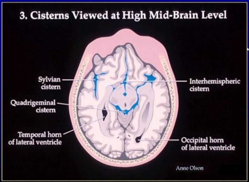 cisterns at high mid brain level.jpg