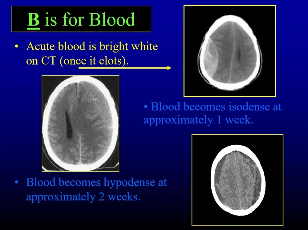 Blood Can Be Very Bad! How to Read an Emergent Head CT — Downeast
