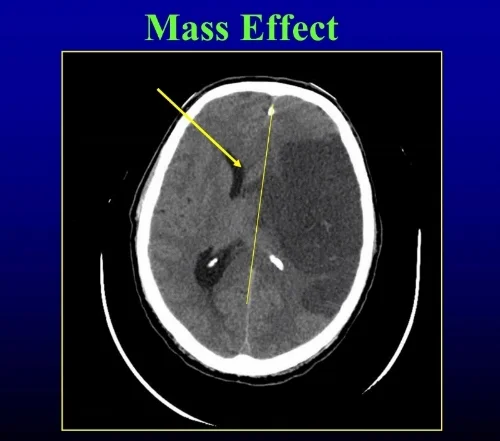 midline shift as measured from septum pellucidum (Arrow)