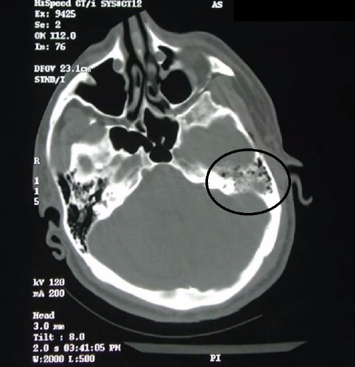 Blood Can Be Very Bad! How to Read an Emergent Head CT — Downeast Emergency Medicine
