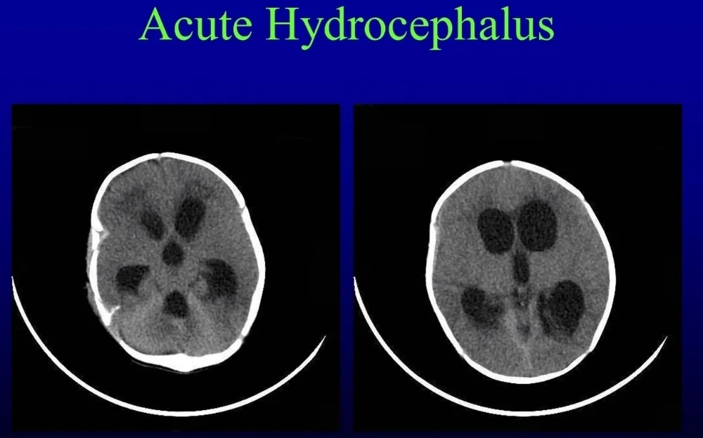 Blood Can Be Very Bad How To Read An Emergent Head CT Downeast 