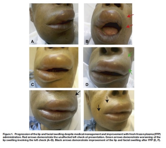 Angioedema pic.jpg