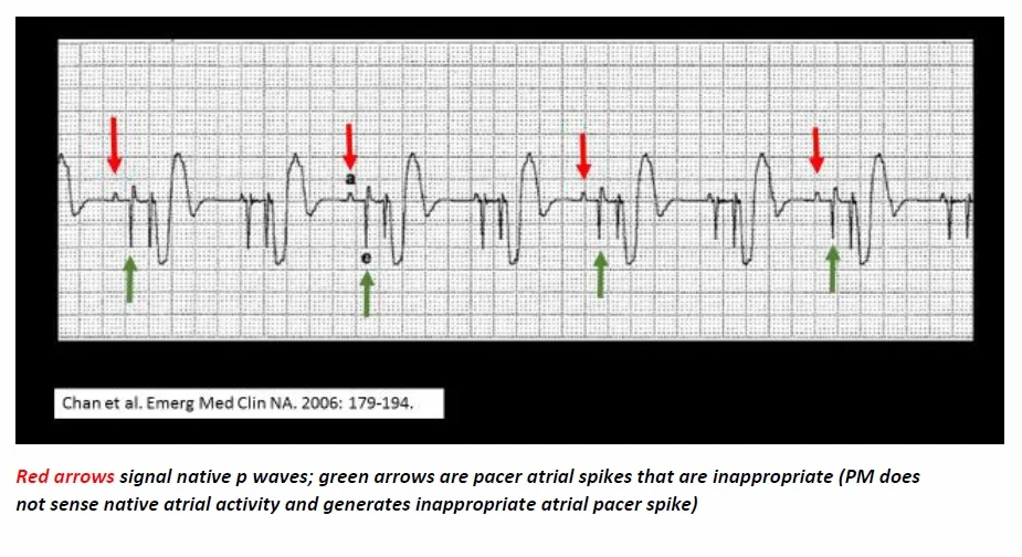 Pacer Not Capture Example Biventricular Pacemaker Failure – SGDX