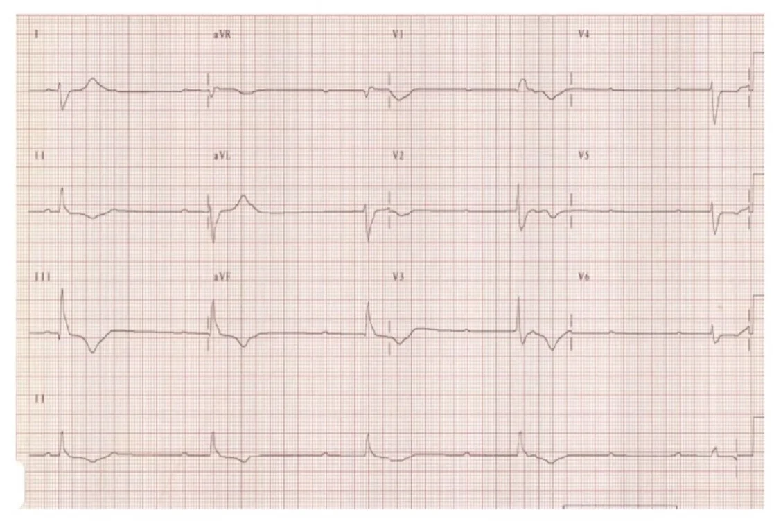 What the Heck is Going on with this Pacemaker?! — Downeast Emergency ...