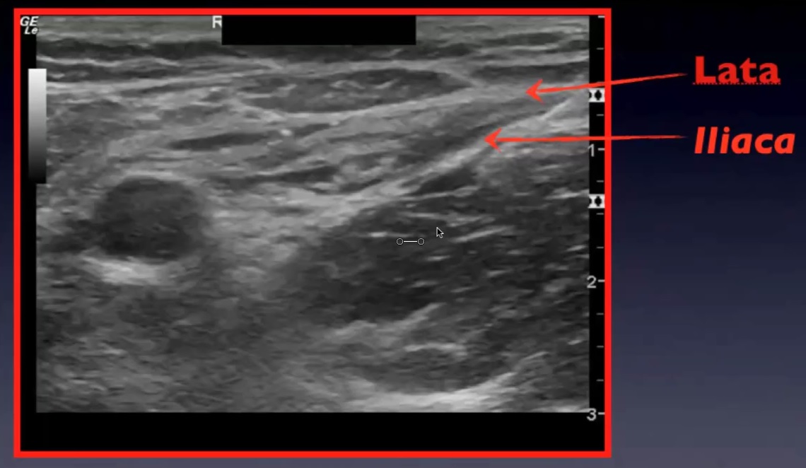 fascial planes.jpg