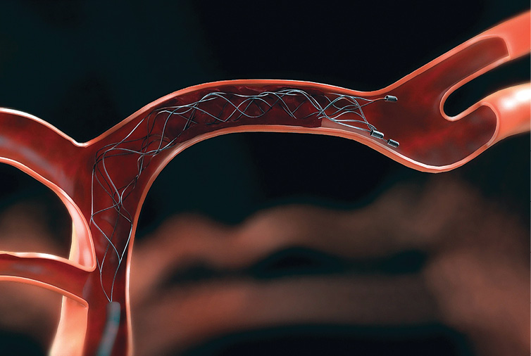 Solitaire-stent-retrieval-device.jpg