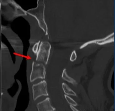 Geriatric+C-Spine+Fractures.jpg