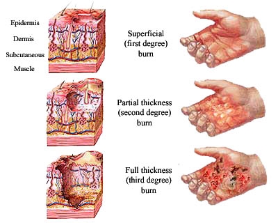 burn-classification.jpg
