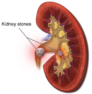 Blausen_0595_KidneyStones.png