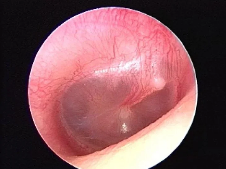 erythematous TM.jpg