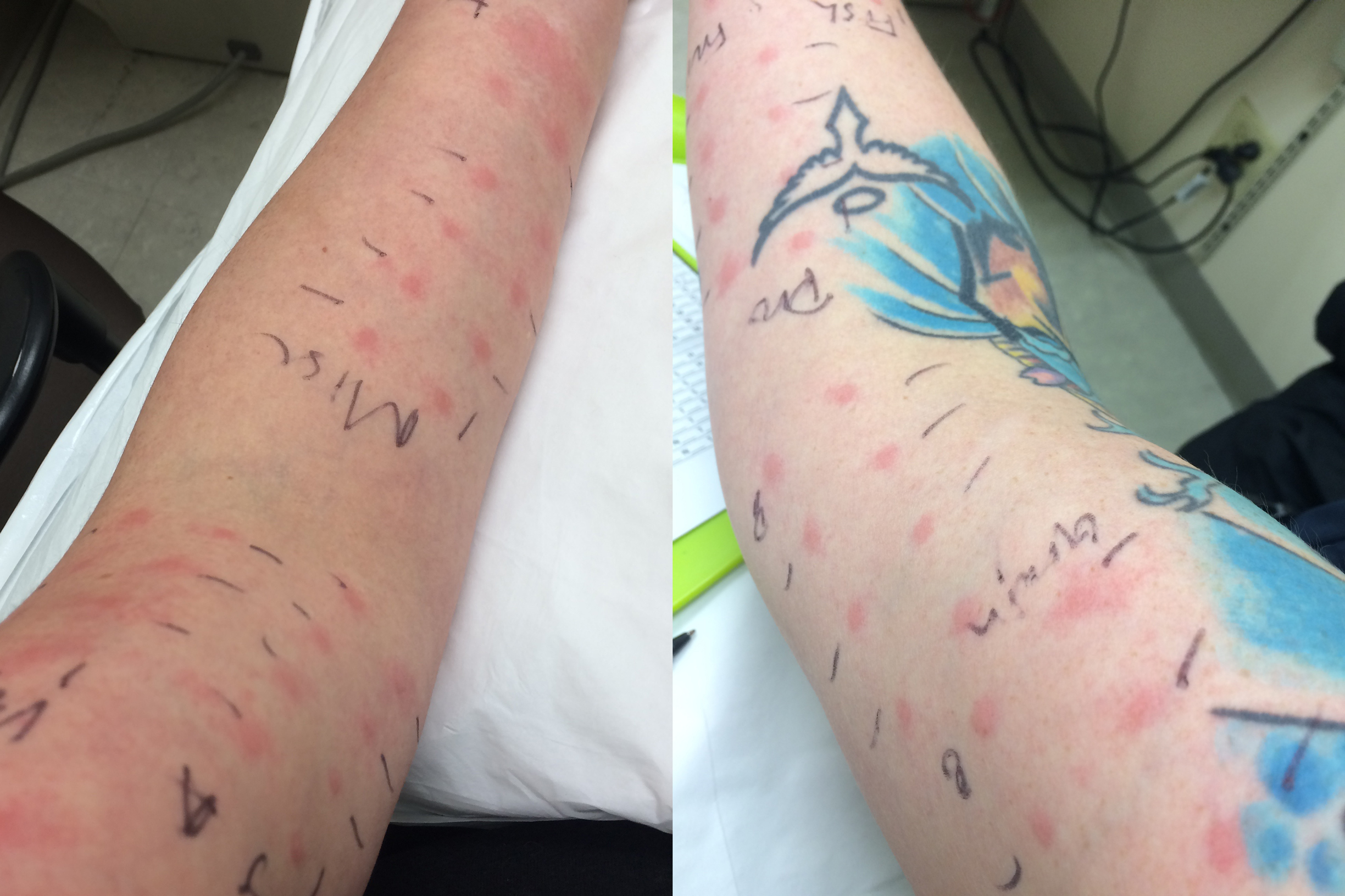 72/72! I can't be allergic to everything... right?