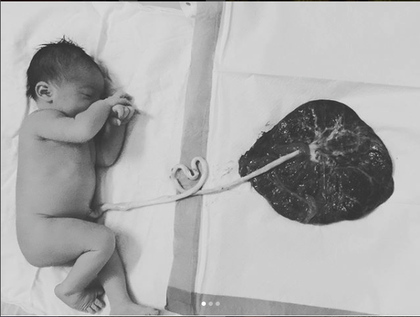 Delayed Cord Clamping