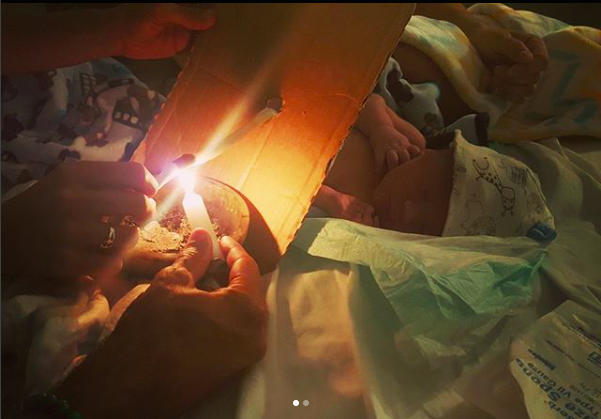Umbilical Cord burning 