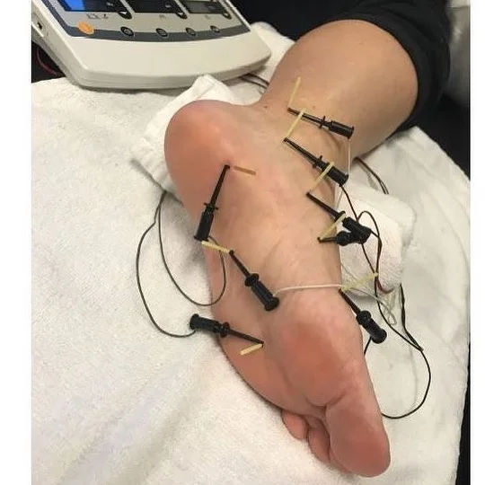 dry needling.jpg