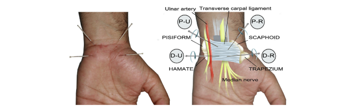 Carpal Tunnel Syndrome Relief in Wake Forest, NC