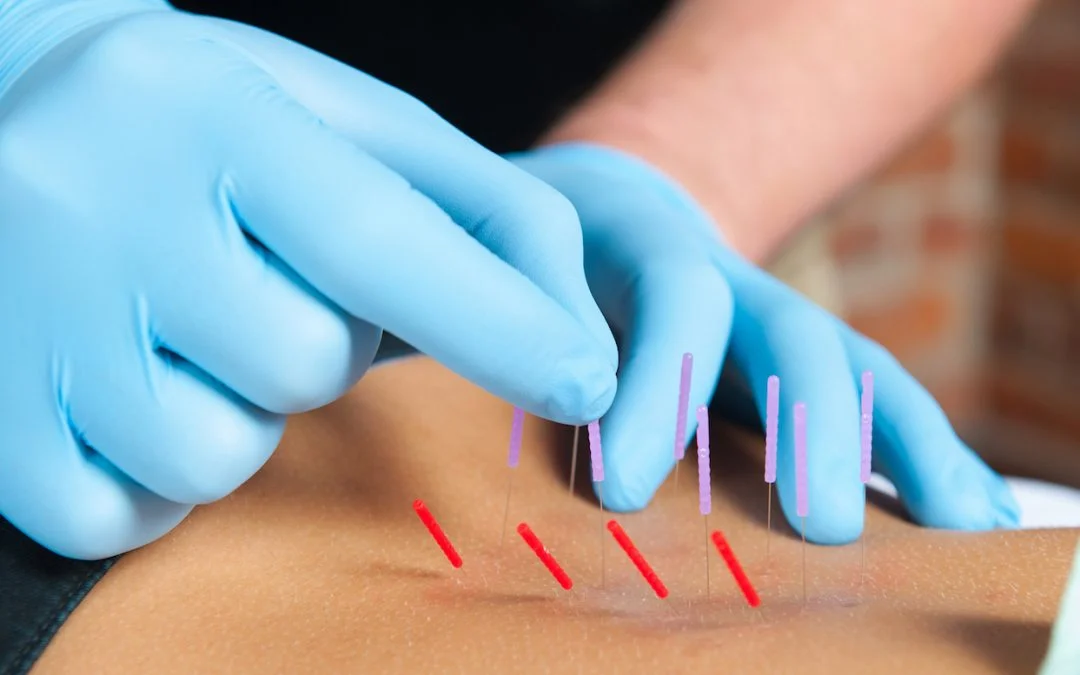 dry needling.jpg