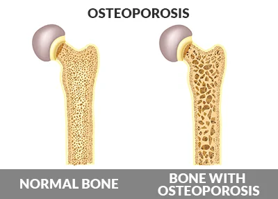 osteoporosis.jpeg
