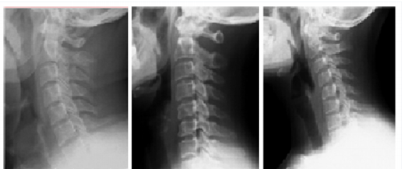 Left picture: Normal Cervical Lordosis Middle picture: Loss of Cervical Lordosis Right picture: Cervical Kyphosis Picture courtesy from: Alpayci et al 2016