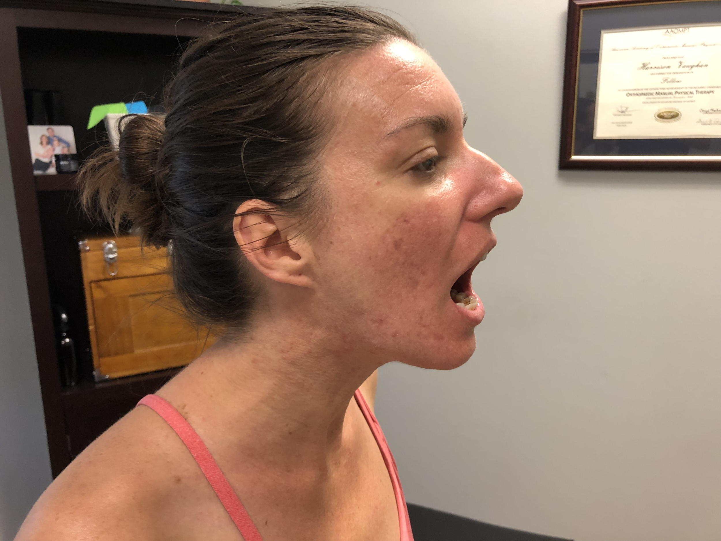 Mandibular depression (mouth opening) with forward posture.