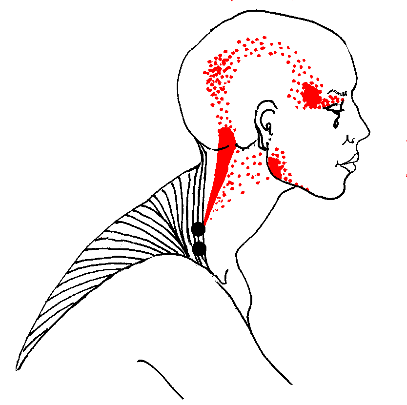 trigger point.gif