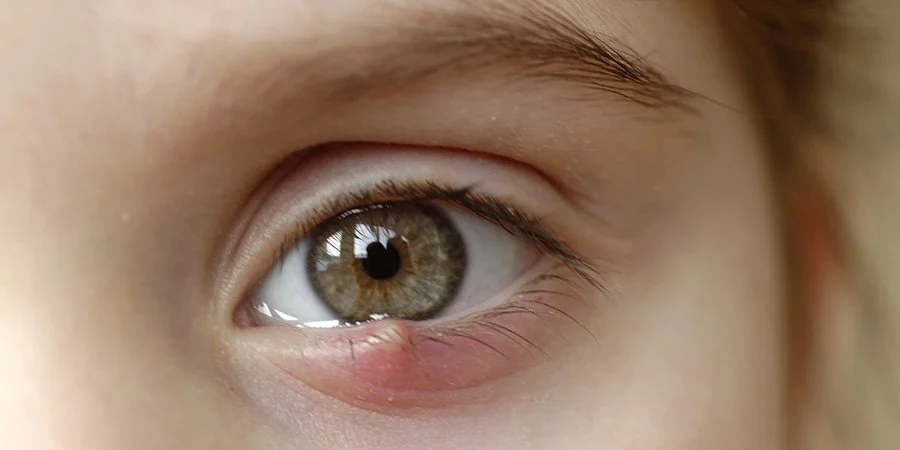 What is a Stye?