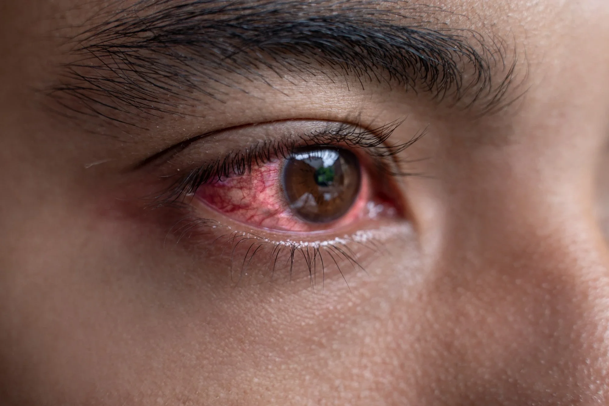 Dry Eye vs. Carrollton Allergies: How to Tell the Difference