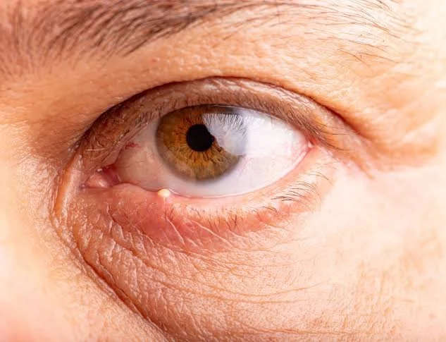 What Is a Stye? Causes, Treatment &amp; When to See an Eye Doctor in Carrollton, GA