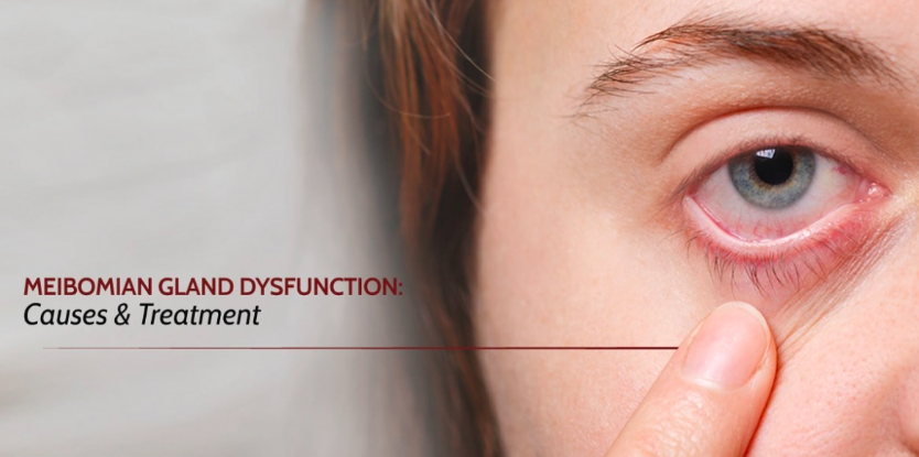 Why Your Eyes Feel Gritty by 3 PM: A Carrollton Eye Doctor Explains Meibomian Gland Dysfunction