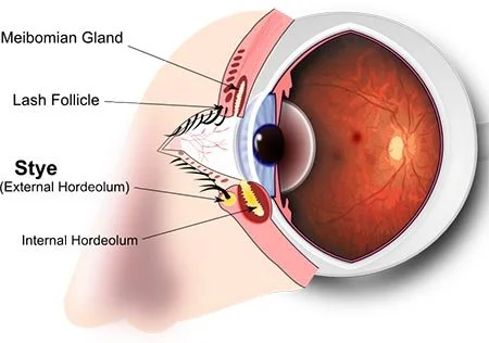 diagram of what a stye looks like in eyeball