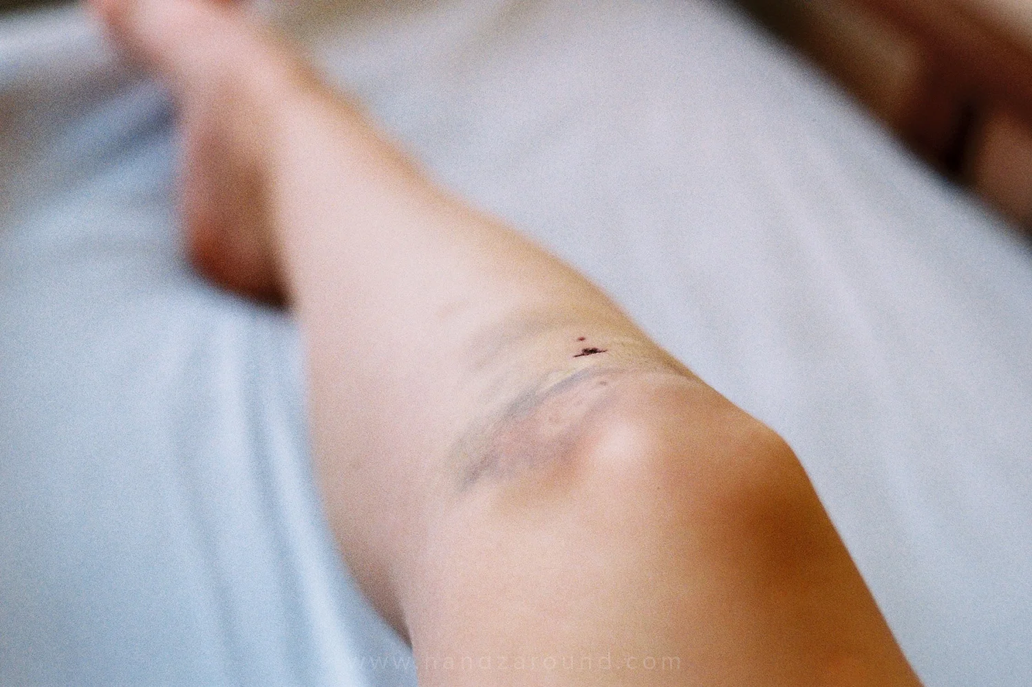 Yet another injury whilst walking around the villages in Kathmandu, Nepal. That time we didn't need the hospital!