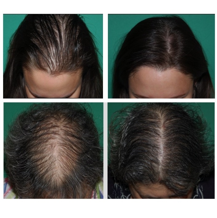 new research on hair loss