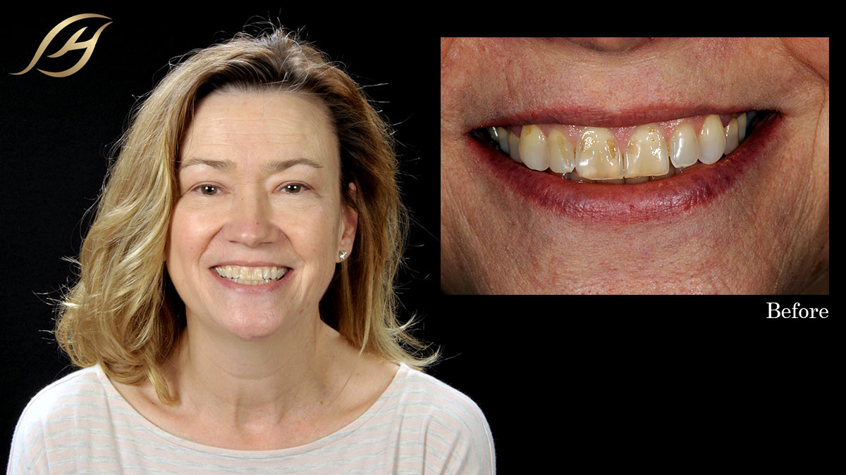 porcelain-veneers-before.jpg