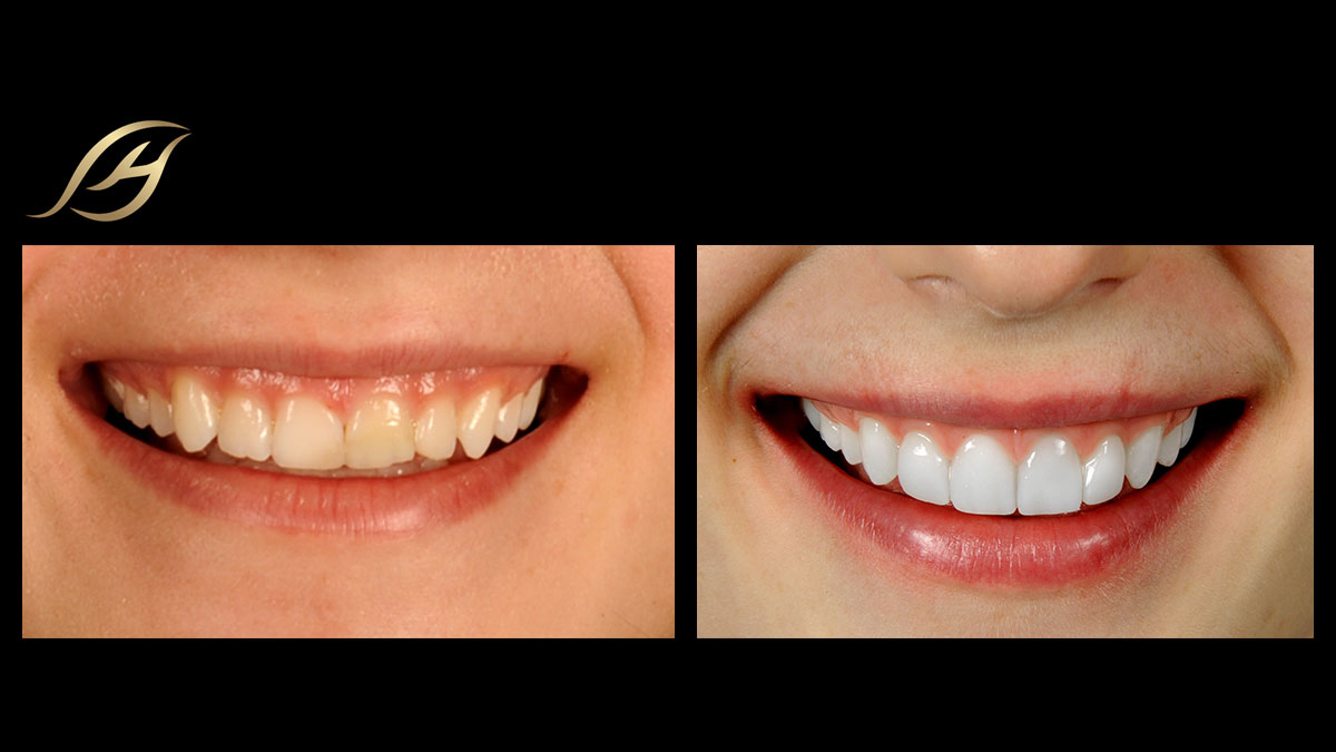 Vampire teeth natural