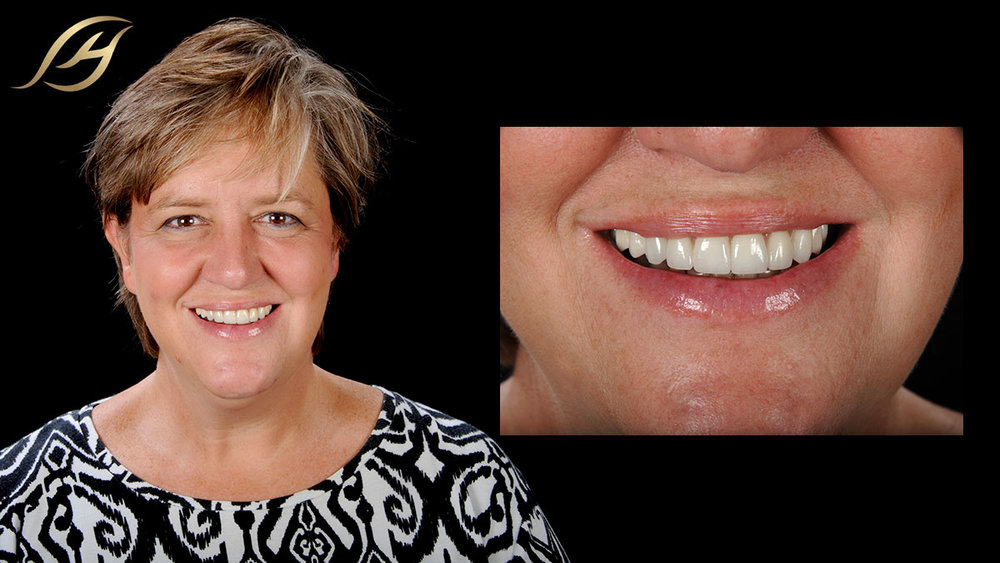 Types of Cosmetic Dentistry and How They Benefit You - Havenview Dental
