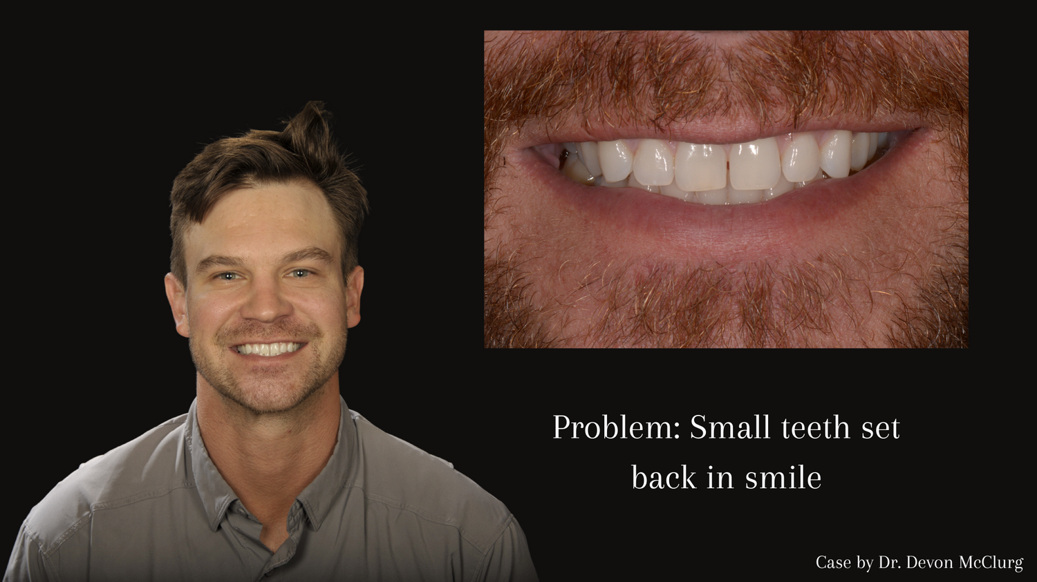Problem_ Stained bonding and uneven smile 16.png