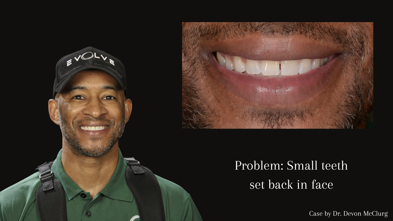 Problem_ Stained bonding and uneven smile 13.png
