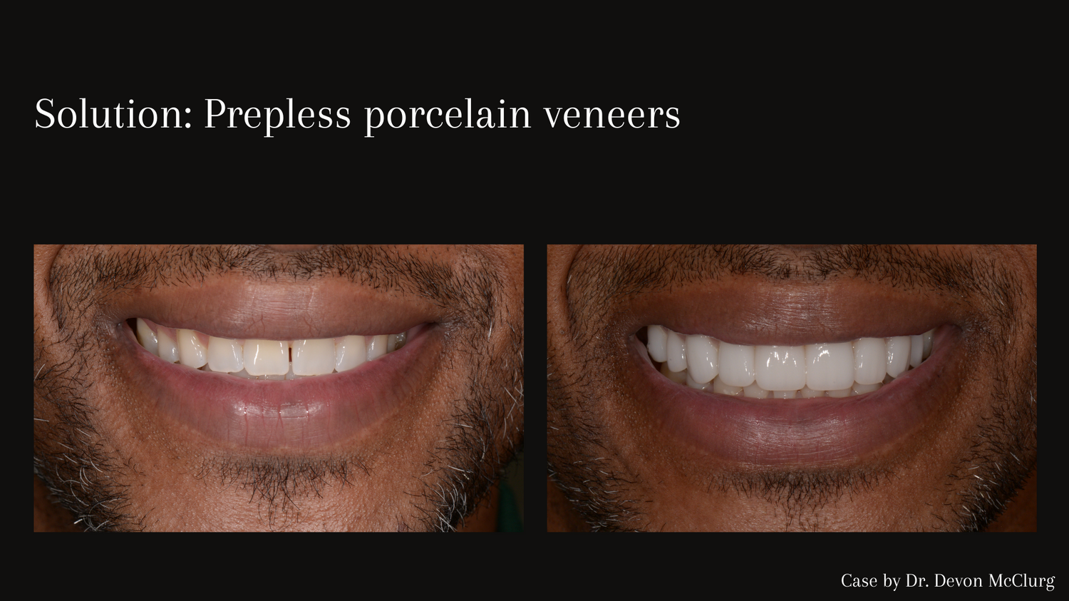 Problem_ Stained bonding and uneven smile 14.png