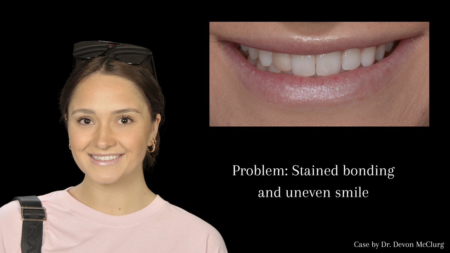 Problem_ Stained bonding and uneven smile 1.png