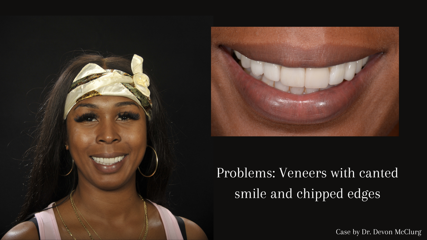 Problem_ Stained bonding and uneven smile 20.png